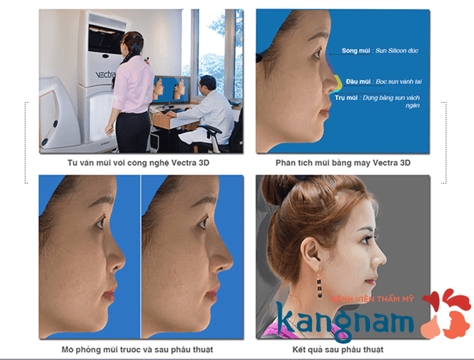Mô hình giải đáp có nên nâng mũi bằng chỉ không?