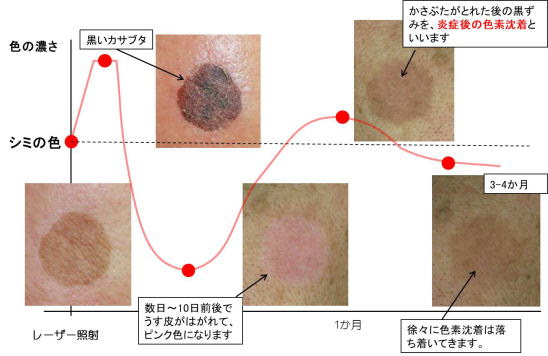肝斑と老人性色素斑