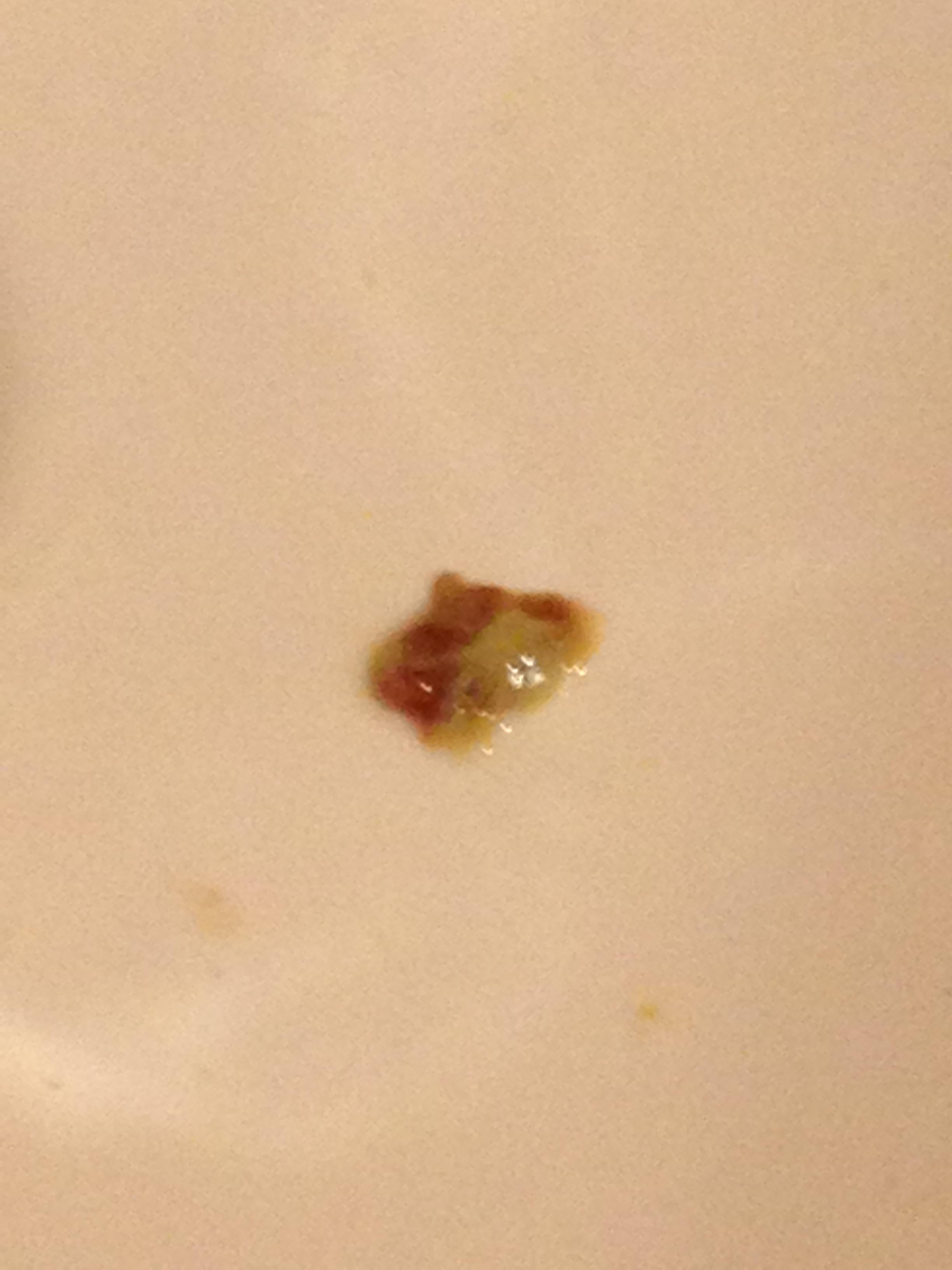 Coughing Up Green Mucus Chunks