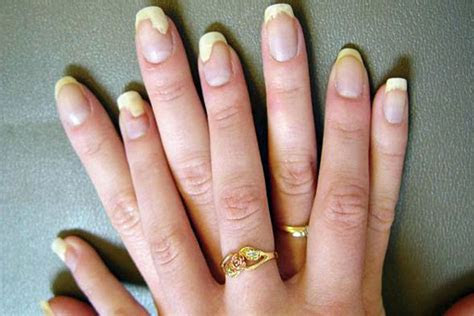 bid goodbye  ugly nails  curing fungal infections