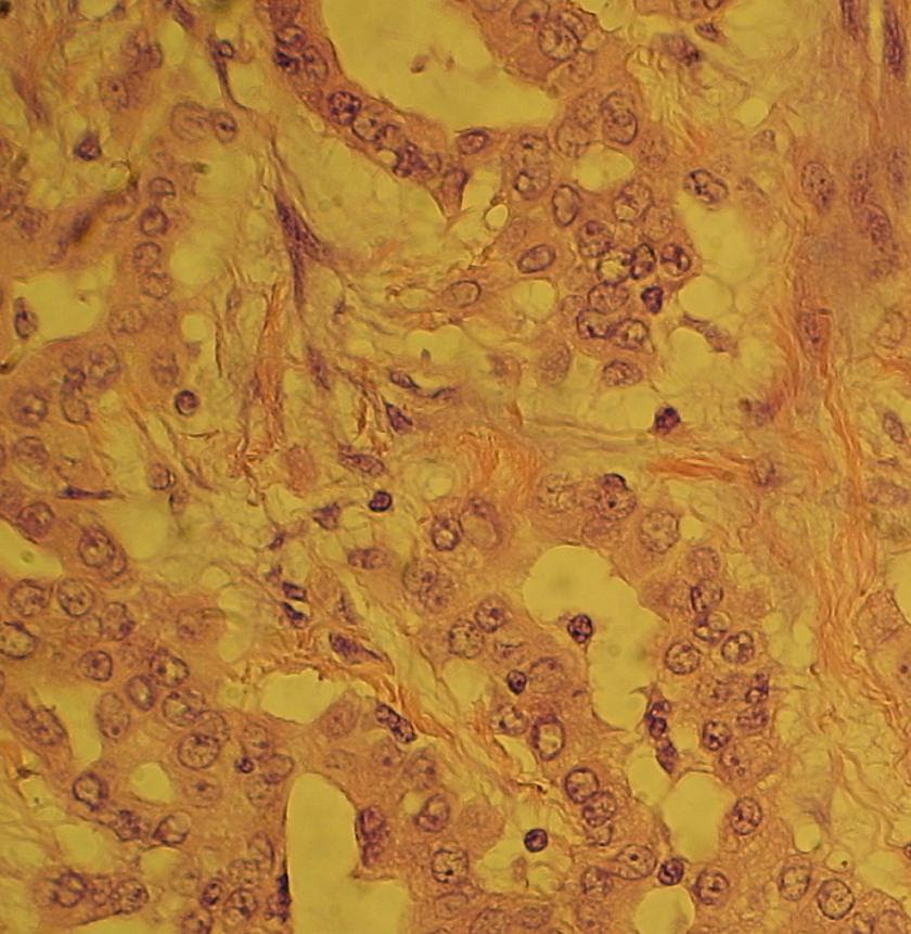 Pathology Outlines - Mesothelioma (malignant)