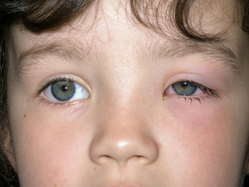 What is Eye (Eyelid) Cellulitis: Symptoms, Diagnosis