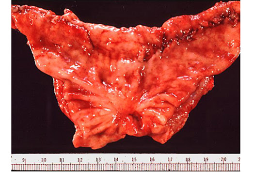 Peptic Ulcer Disease. of peptic ulcer disease.