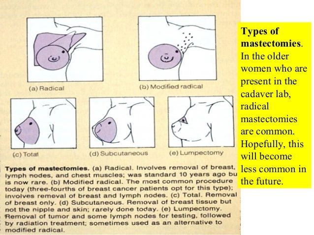 laser treatment for cervical cancer