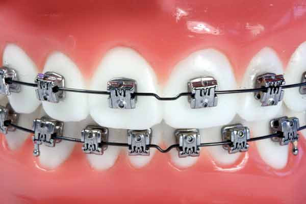 Self ligating brackets in orthodontics