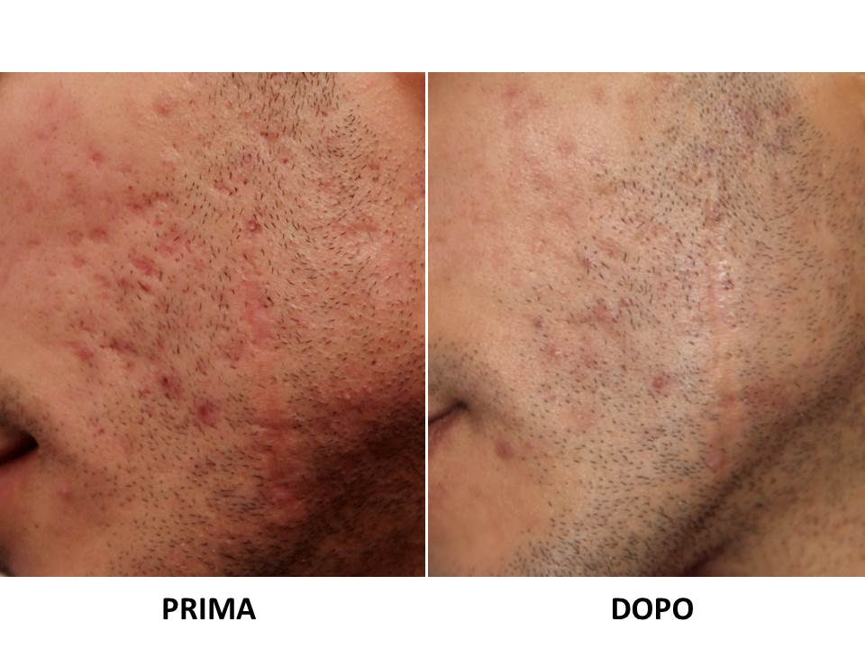 trattamenti viso per cicatrici acne