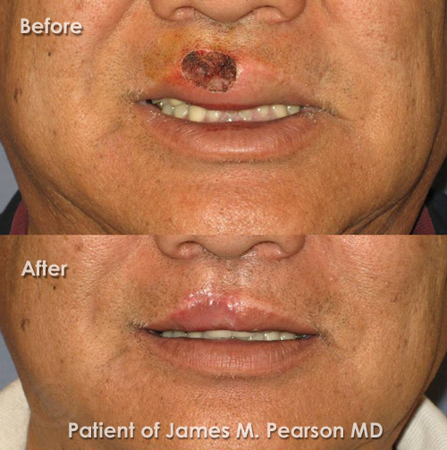Lip Reconstruction Dr James Pearson Facial Plastic Surgery