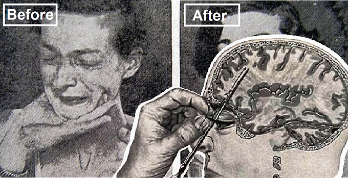 These 16 Before And After Photos of People from Horror of the Lobotomy