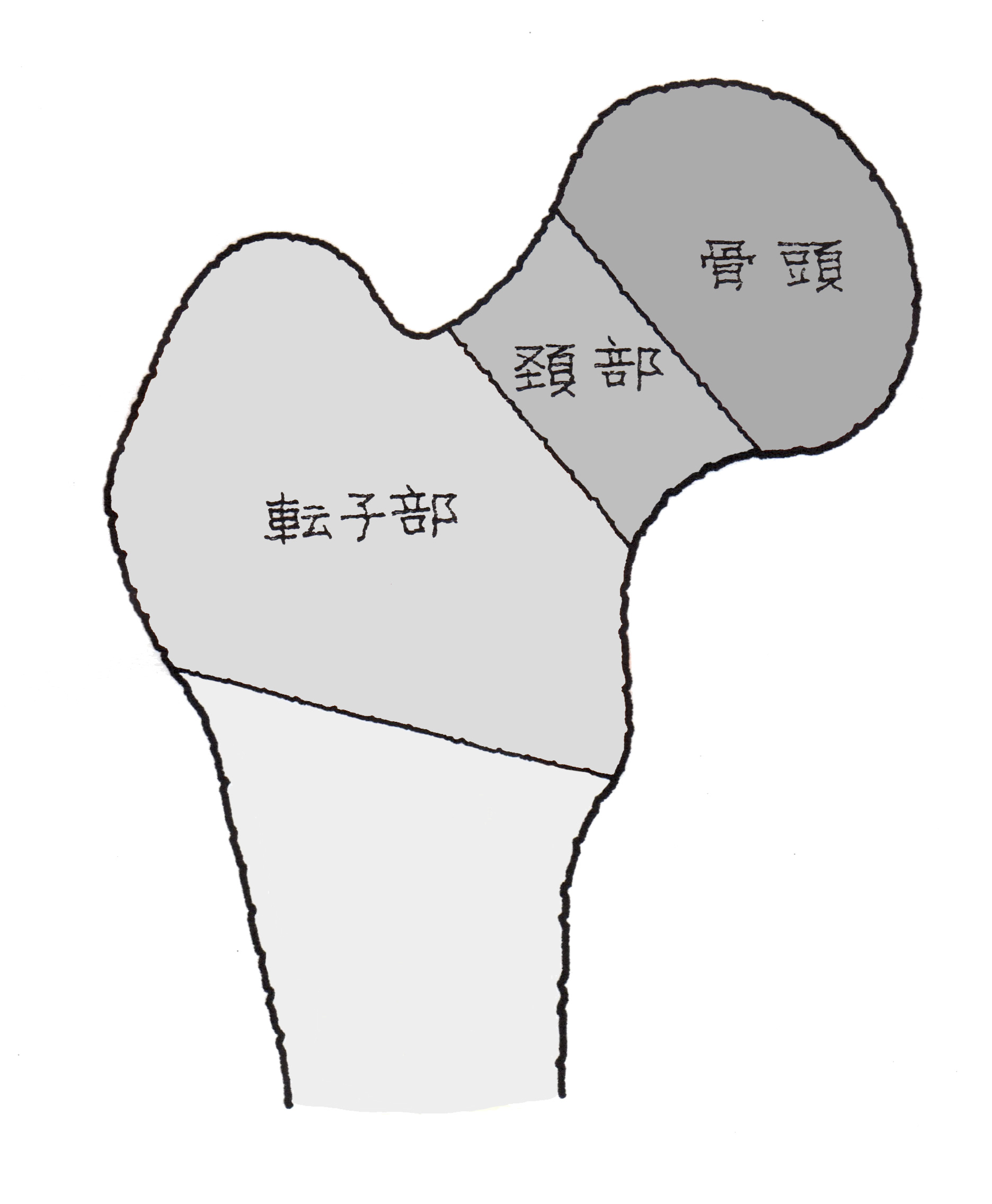 大腿骨頚部骨折 だいたいこつけいぶこっせつ 福岡の弁護士による後遺障害 等級認定サポート