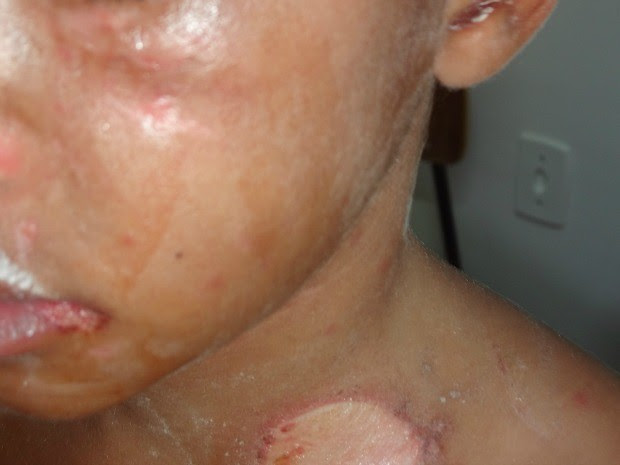 Criança tinha várias marcas de queimaduras e de agressões (Foto: Divulgação/ Polícia Civil)
