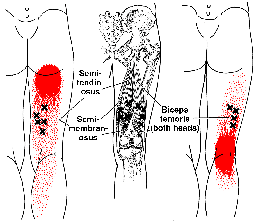 Oberschenkelmuskel The Trigger Point Referred Pain Guide