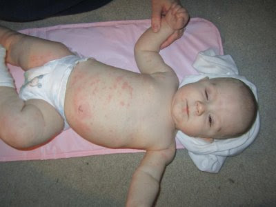 heat rash on face treatment. heat rash on face pictures.