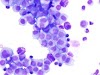 Sarcomatoid Mesothelioma Of Pleural - Sarcomatoid Mesothelioma with Osteoid Differentiation - Journal of