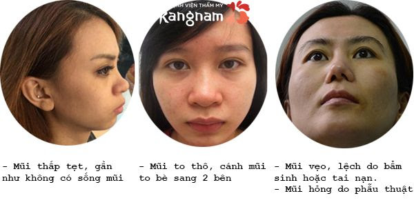 nâng mũi cấu trúc 4D NanoForm1