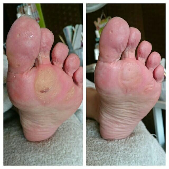 角質ケア 大阪市本町 フットスタジオ アルク