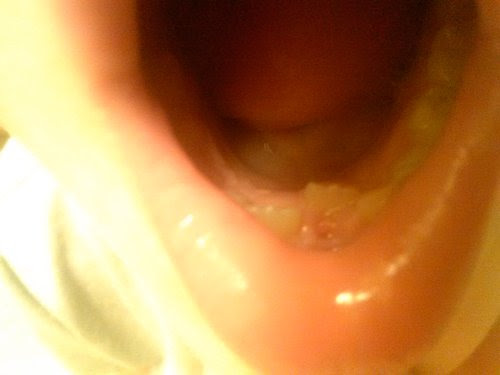 Sons Tooth Fell Out Root Still In There Pics Added Babycenter