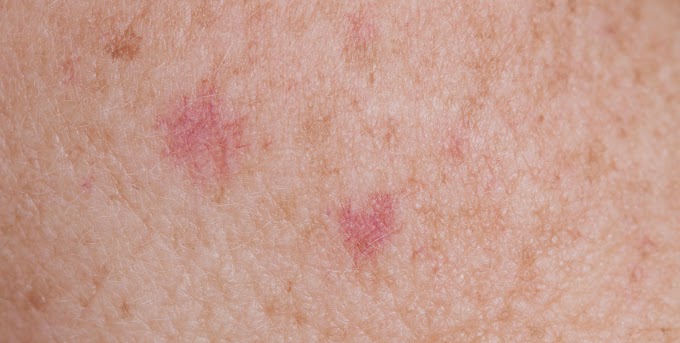 Skin Cancer Untreated - Basal Cell Carcinoma | Q Dermatology - The patches could develop into squamous cell carcinoma (scc) if untreated.