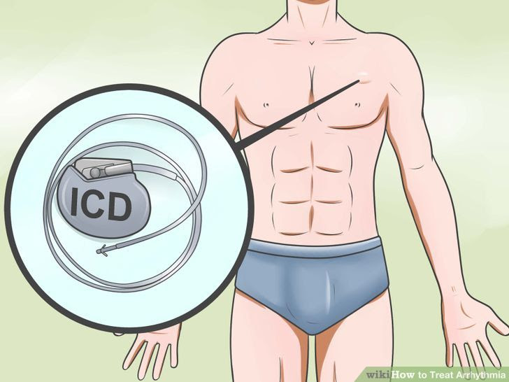 Treat Arrhythmia Step 14 Version 2.jpg