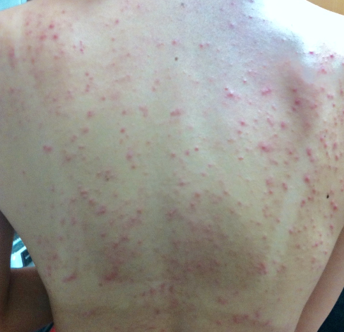 背中 かゆい ぶつぶつ 背中やお腹の赤いブツブツの原因と対処法 痒くない時と痒い発疹の違いとは