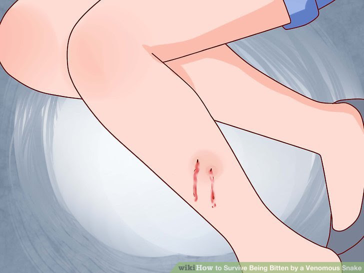 Survive Being Bitten by a Venomous Snake Step 4 Version 2.jpg