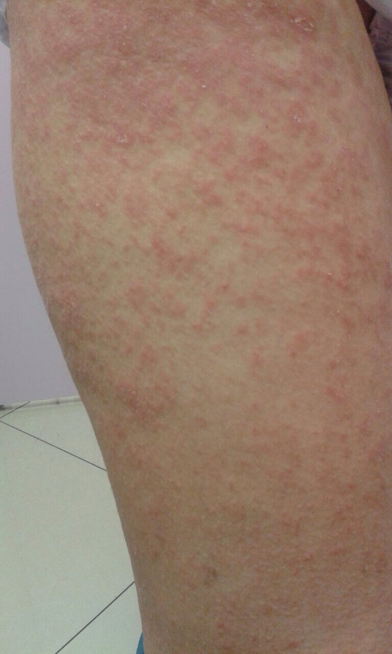 Rashes - ExpressCare Guam Clinic | Doctors for Medical ...