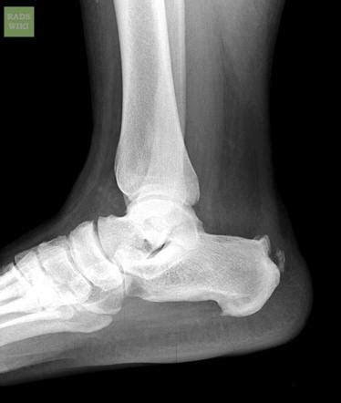 This is a condition in which your plantar fascia, a ligament in your foot that connects your toes to your heel, tightens up. Haglund deformity | Image | Radiopaedia.org