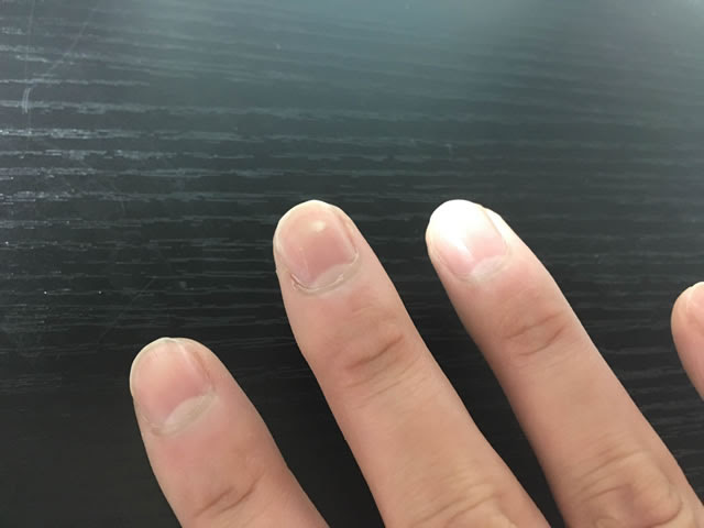 爪に現れる白い点は病気じゃなく幸運の訪れを知らせるサインだった 指ごとに意味が違うらしい I Live Freely