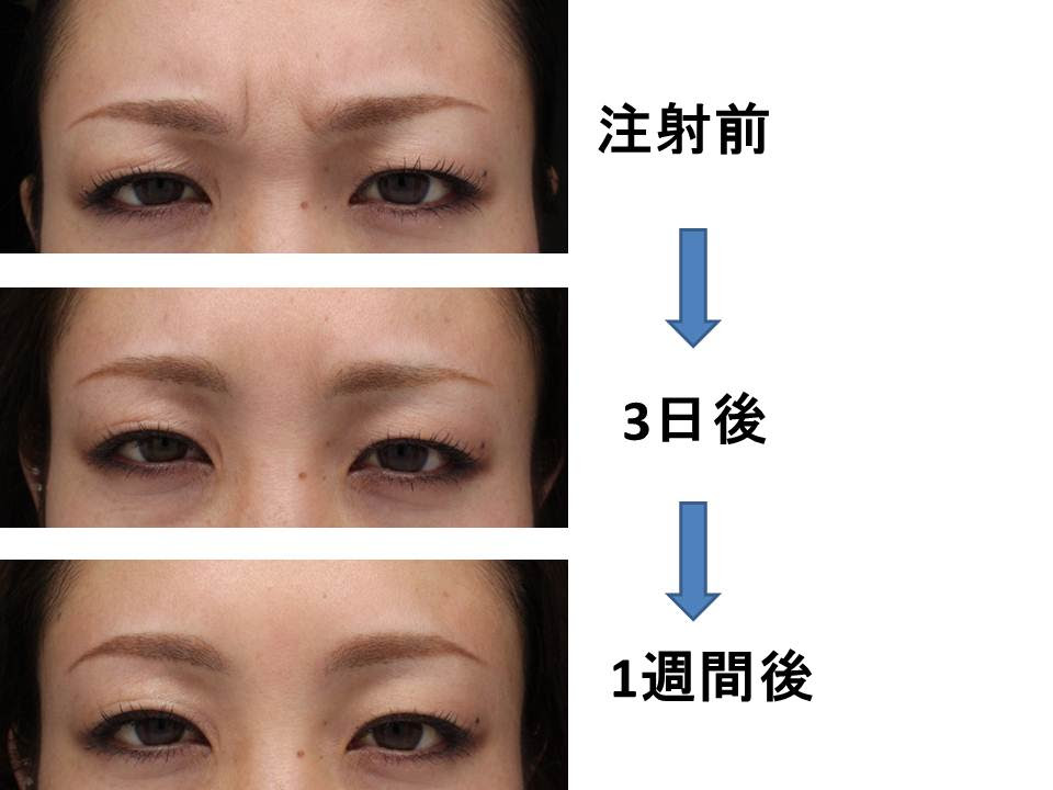 北村理子クリニック皮ふ形成外科 ブログ 症例