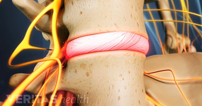 Weight Loss Medication Australia : Sciatica Surgery : While some people simply are unhappy with the way that their clothes fit, others are clinically obese.