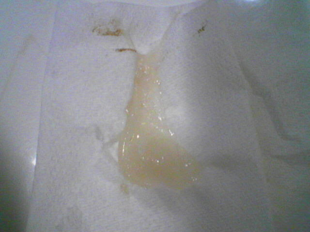 Cellenritiespicture Girl Mucous Plug Not For The Faint The mucus plug is a collection of cervical mucus that helps block the cervix during pregnancy. cellenritiespicture girl blogger