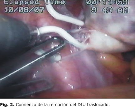 Migracion De Un Dispositivo Intrauterino Al Ovario