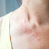 Hepatitis Ausschlag : Erneut Anaphylaxie Nach Covid 19 Impfung / Häufig wird ausschlag durch allergien verursacht.