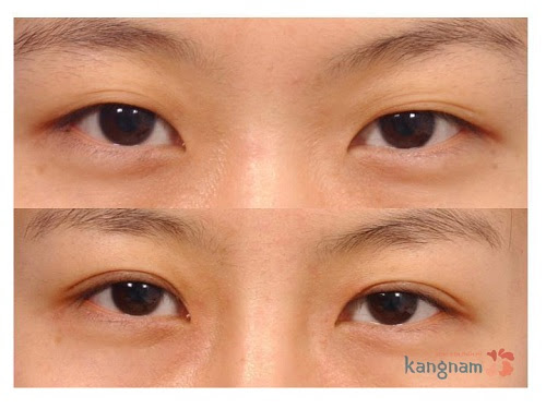 Phẫu thuật cắt mỡ mắt3567 