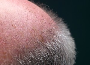 Calvizie, speranze per la cura tutto dipende dalle staminali "dormienti"