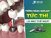 Cắm implant tức: Ưu và nhược điểm 