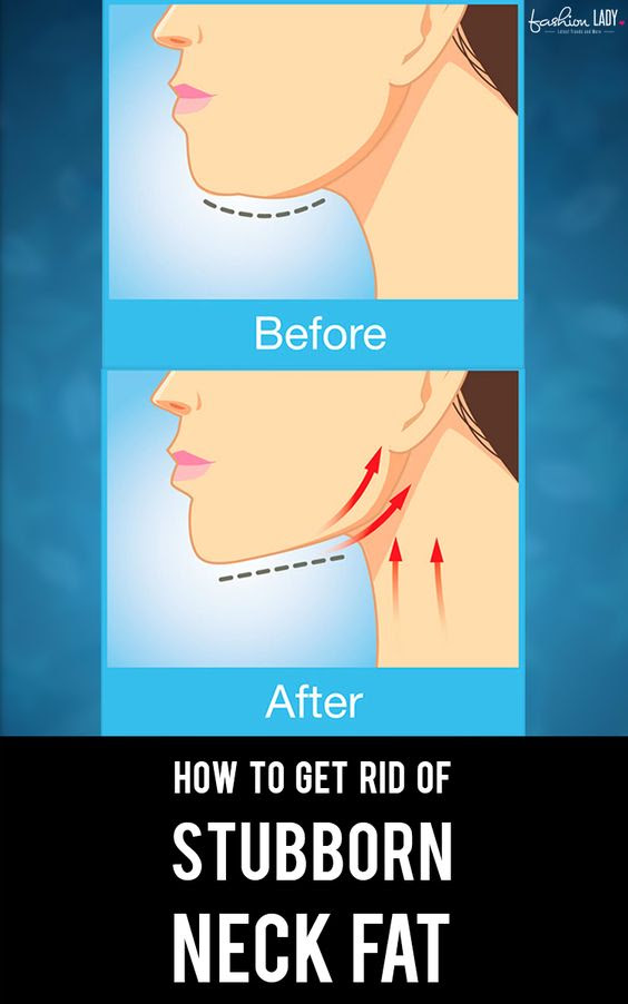 How to Get Rid of Neck Fat to Improve the Way you Look