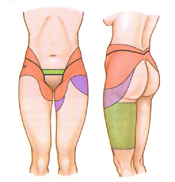 body lift