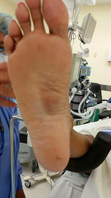 Plantar fasciitis is a common cause of foot pain, with discomfort concentrated at the heel. Dr. K. Lam Straight Talk: Bump on bottom foot aka plantar