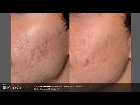 Laser acne scar removal treatment by Pulse Light Clinic