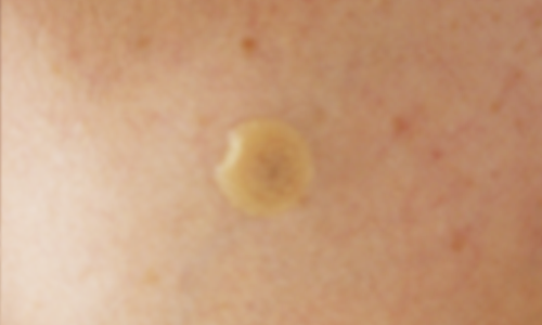 できもの 良性腫瘍 すがも小林皮フ科