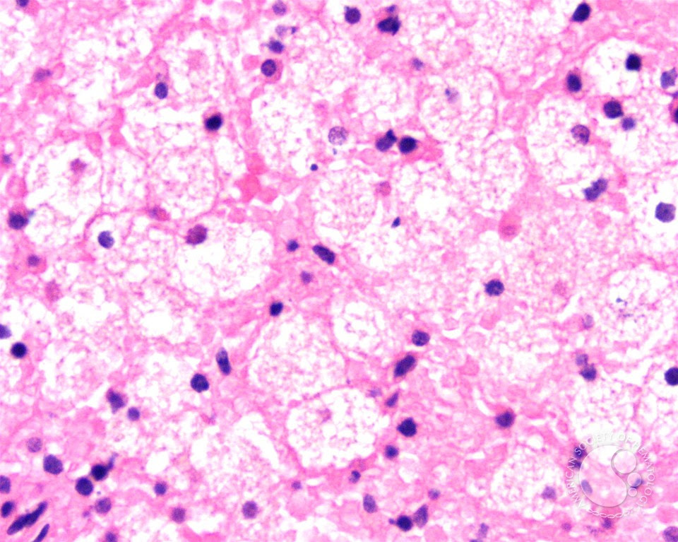 Splenic involvement in Niemann Pick disease - 4.