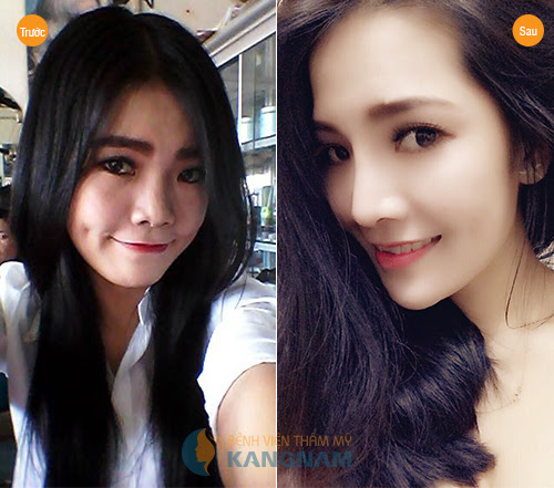 nang-mui-su-dung-duoc-bao-lau-co-duoc-vinh-vien-khong2