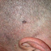 Skin Cancer Early Symptoms Pictures : Bowen's disease skin cancer - Stock Image C029/6385 / There are a number of different treatments doctors recommend.