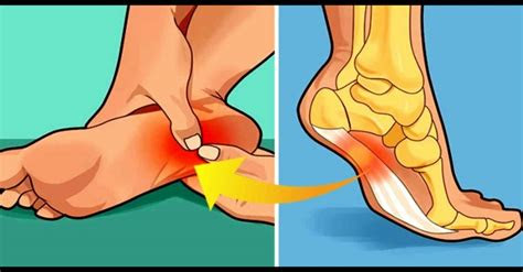 La fascitis plantar es la inflamación del tejido grueso en la planta o parte inferior del pie. Esta Es La RazÃ³n Del Dolor De TalÃ³n Por Las MaÃ±anas O