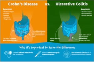 Like with crohn's disease and ulcerative colitis, the cause of ibs is not fully understood. Crohn's Disease vs Ulcerative Colitis - Woburn Osteopaths