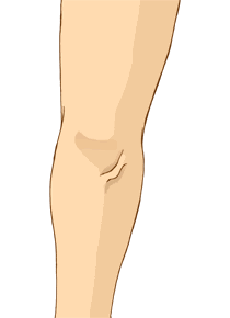 下肢静脈瘤の症状 ドクターが推薦する専門医療機関