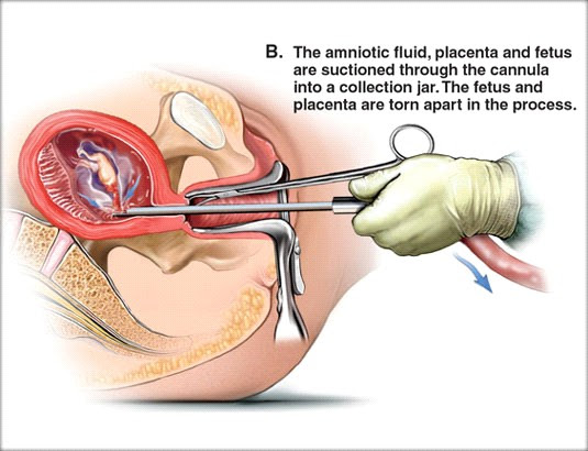 abortion2 abortion2