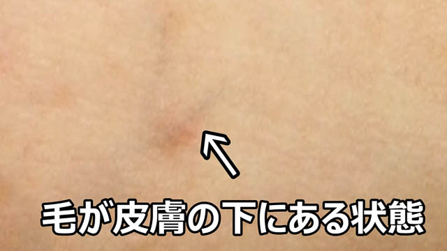 悲報 脱毛は皮膚の炎症更に埋没毛などのデメリットが カズチャンネル