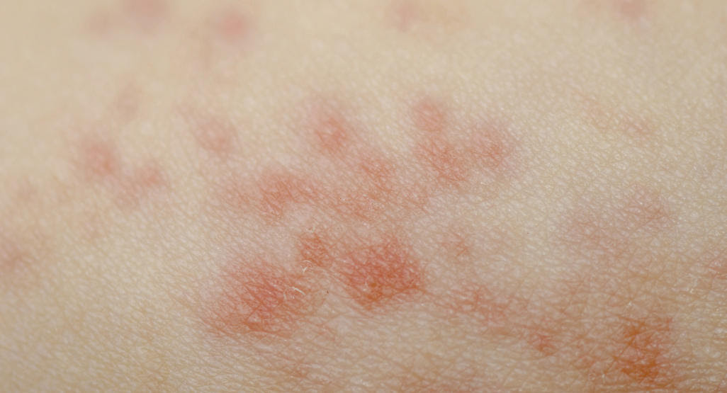 Baby dry scalp treatment