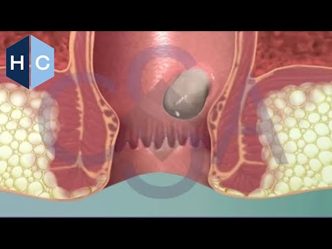 internal hemorrhoids bleeding